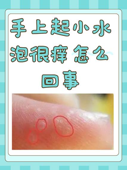 手上起水泡痒痒的是什么原因缩略图