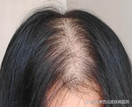 女性脂溢性脱发图片