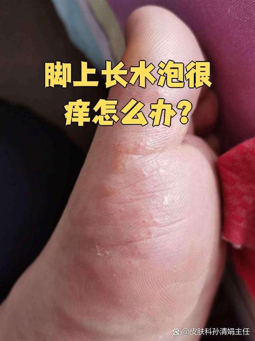 脚上长水泡又痒是什么原因缩略图