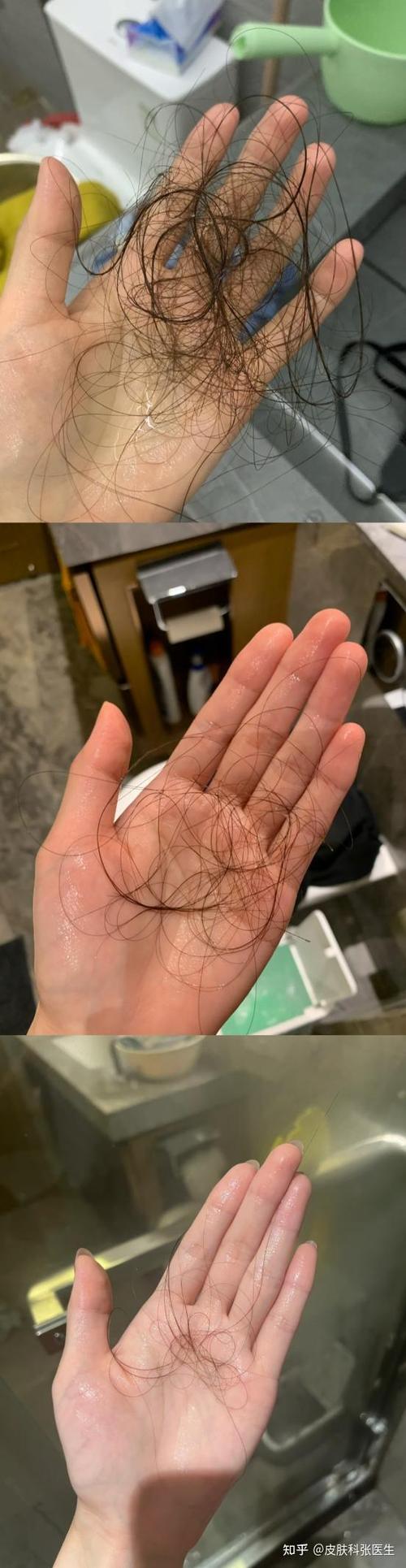 女性脂溢脱发症状图标