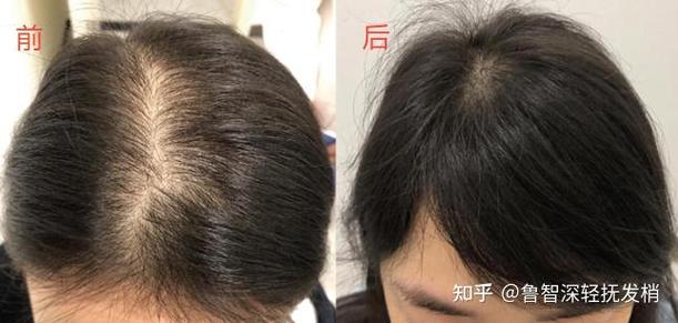 脂溢性脱发用什么药最有效图标