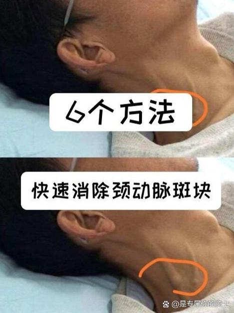 怎么去斑块最快最有效