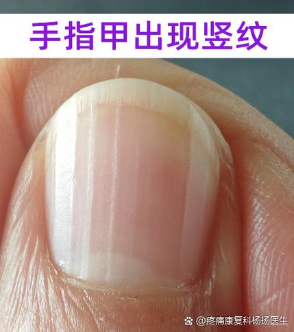 手大拇指有竖纹是什么原因图标