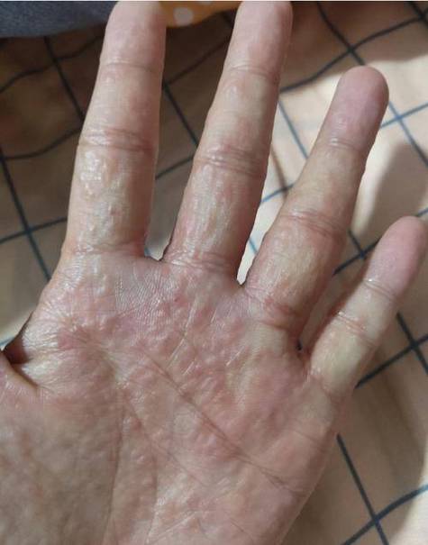 手丫子起水泡是什么原因缩略图