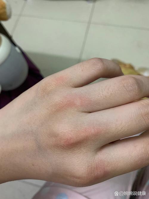 红手指一直闪退