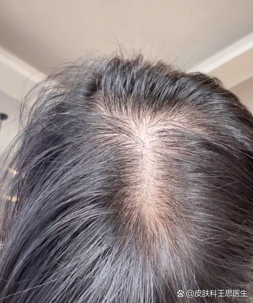 脂溢性脱发能长回来吗图标