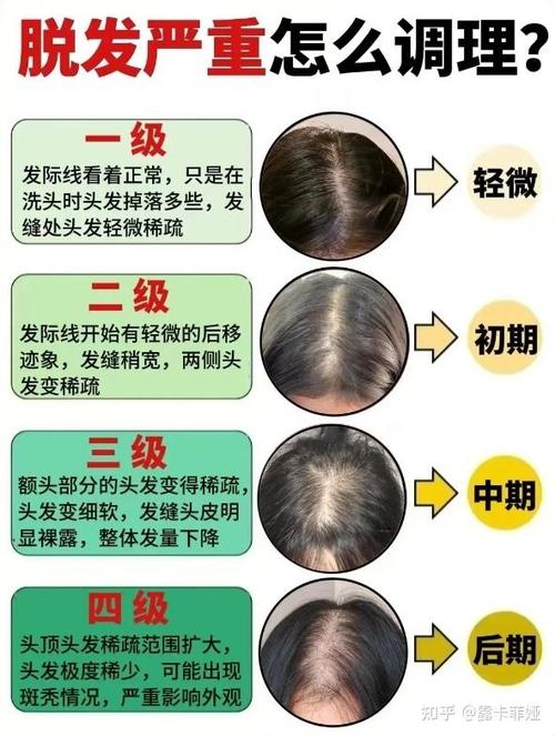 女性脂溢性脱发怎么治疗最有效图标