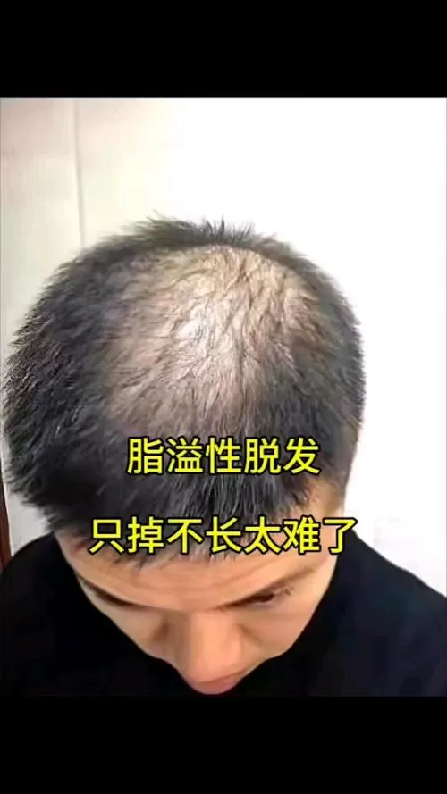 脂溢性脱发一年了还能长出来吗图标